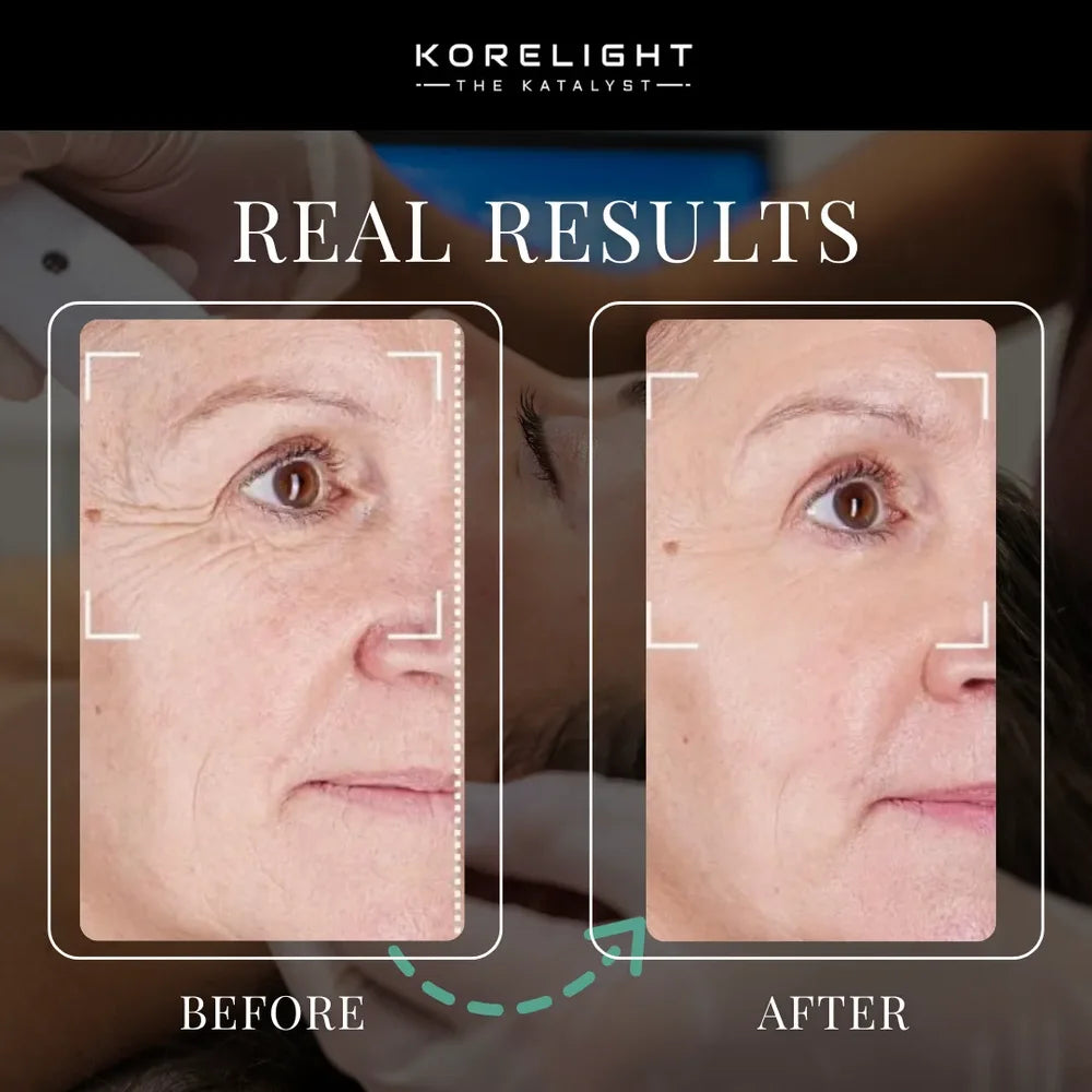 Smoother eye-area skin after sessions in Kore ELITE Light Therapy Beds, shown in a before and after comparison