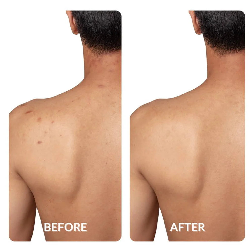 Back and shoulder acne cleared in a before and after comparison using Spacetouch Capsule blue light sessions