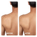 Back and shoulder acne cleared in a before and after comparison using Spacetouch Capsule blue light sessions