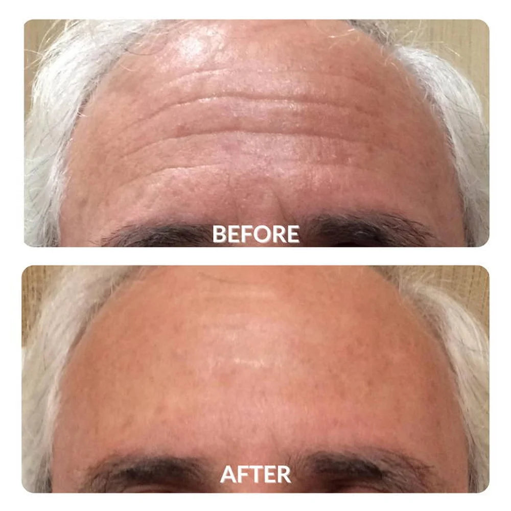 Stacked forehead wrinkle comparison on a grey-haired man after Galaxy Zero Capsule Infrared Light Therapy sessions