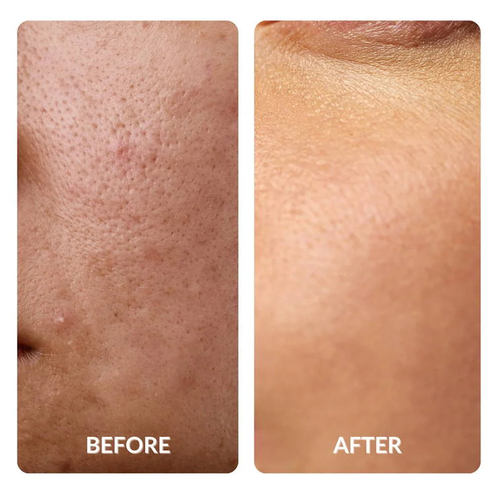 Close-up of rough pitted cheek skin refined after treatment with the Galaxy Zero USA Capsule