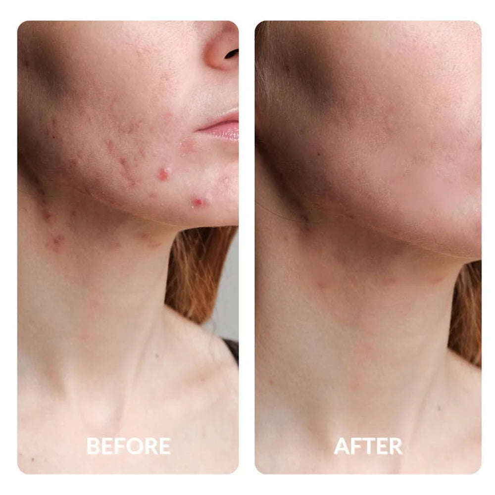 Inflamed jawline acne calmed in a before and after set after Galaxy Zero Capsule Full Body Light Therapy sessions