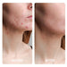 Inflamed jawline acne calmed in a before and after set after Galaxy Zero Capsule Full Body Light Therapy sessions