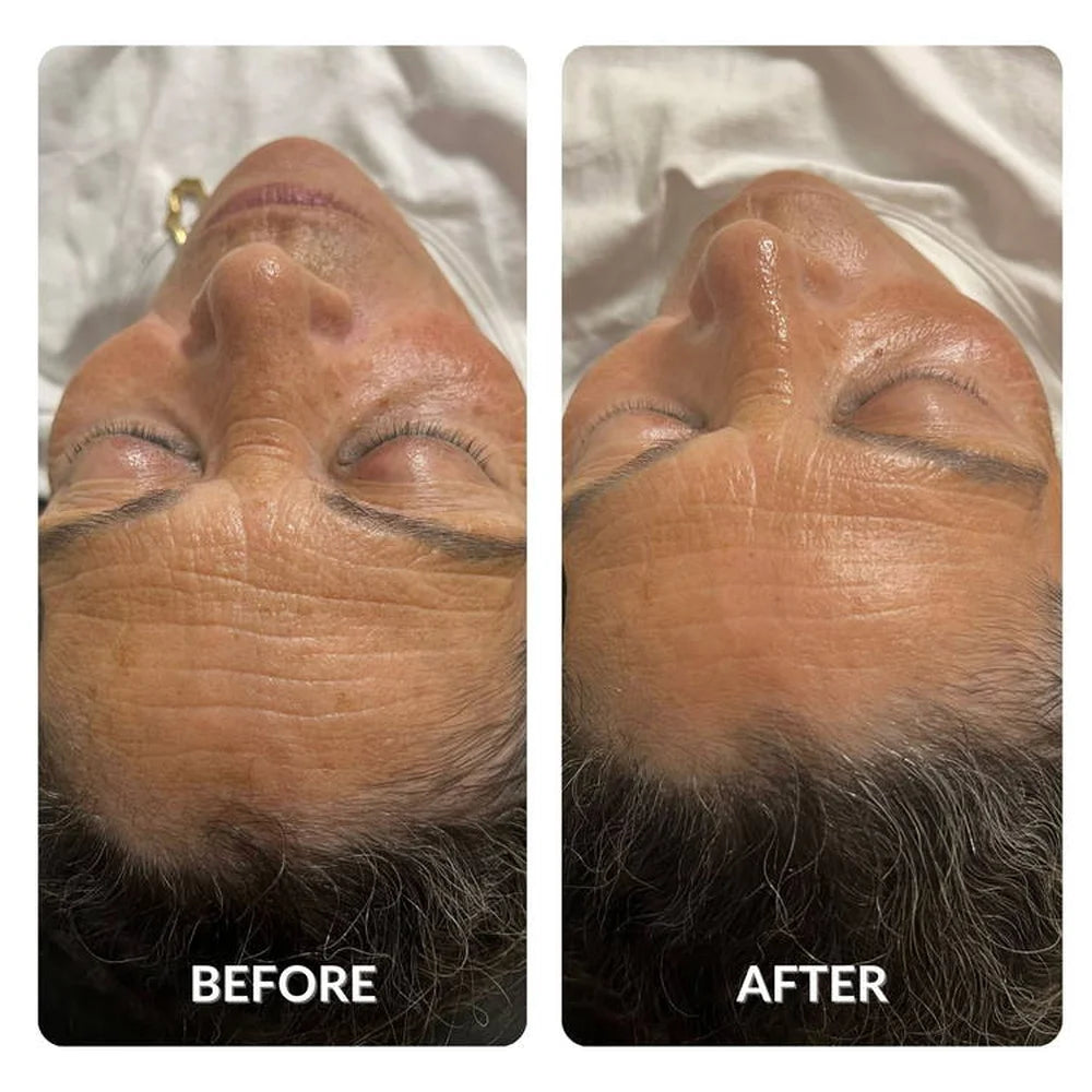 Overhead before and after of forehead creases reduced through Galaxy Zero Capsule Red Light Therapy treatment