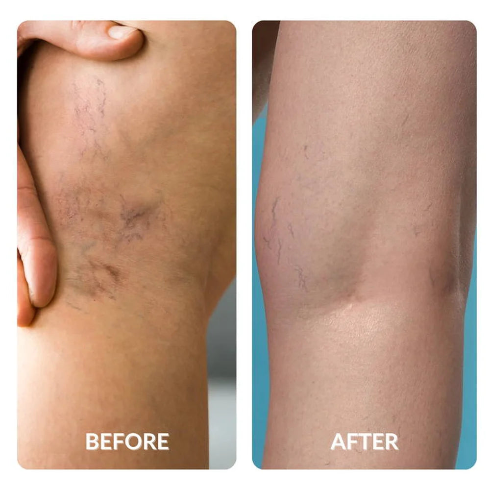Spider veins behind the knee visibly reduced in a before and after pair using the Spacetouch Capsule