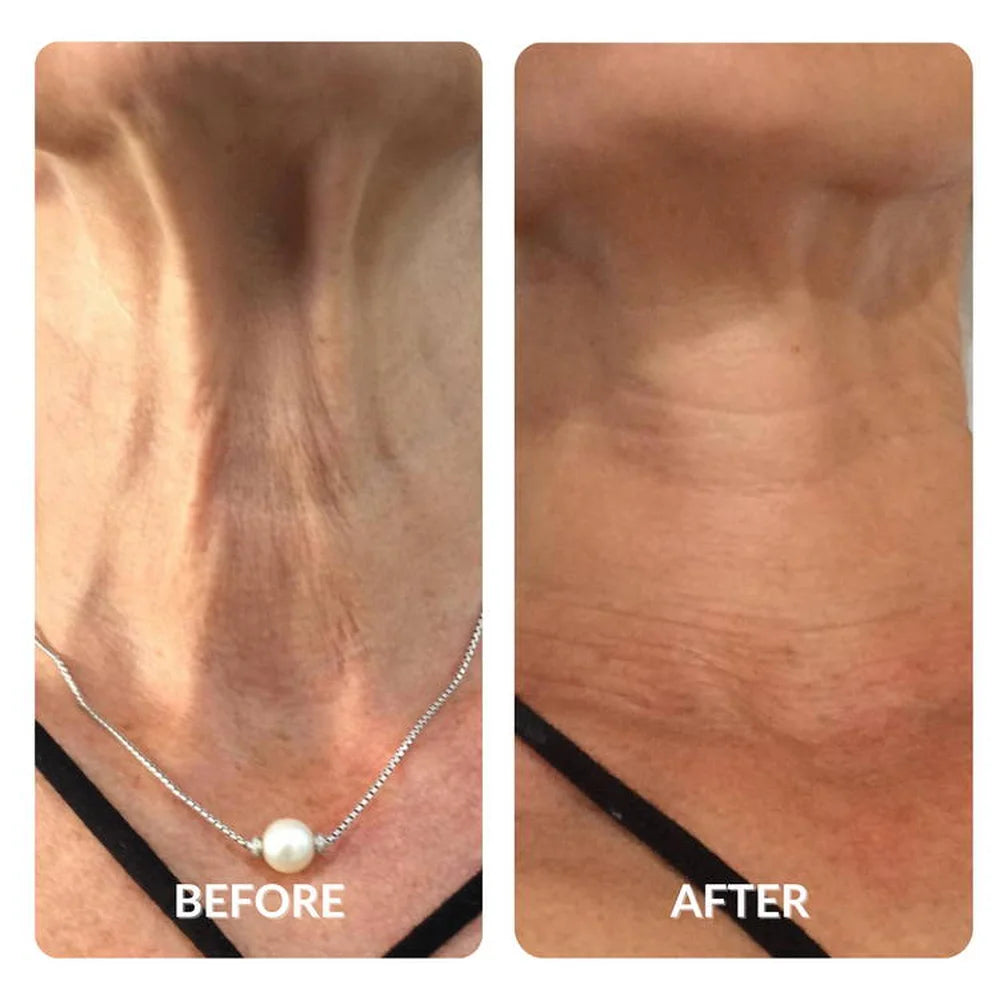 Neck and chest skin firming before and after results from Galaxy Zero Capsule Red Light Therapy sessions