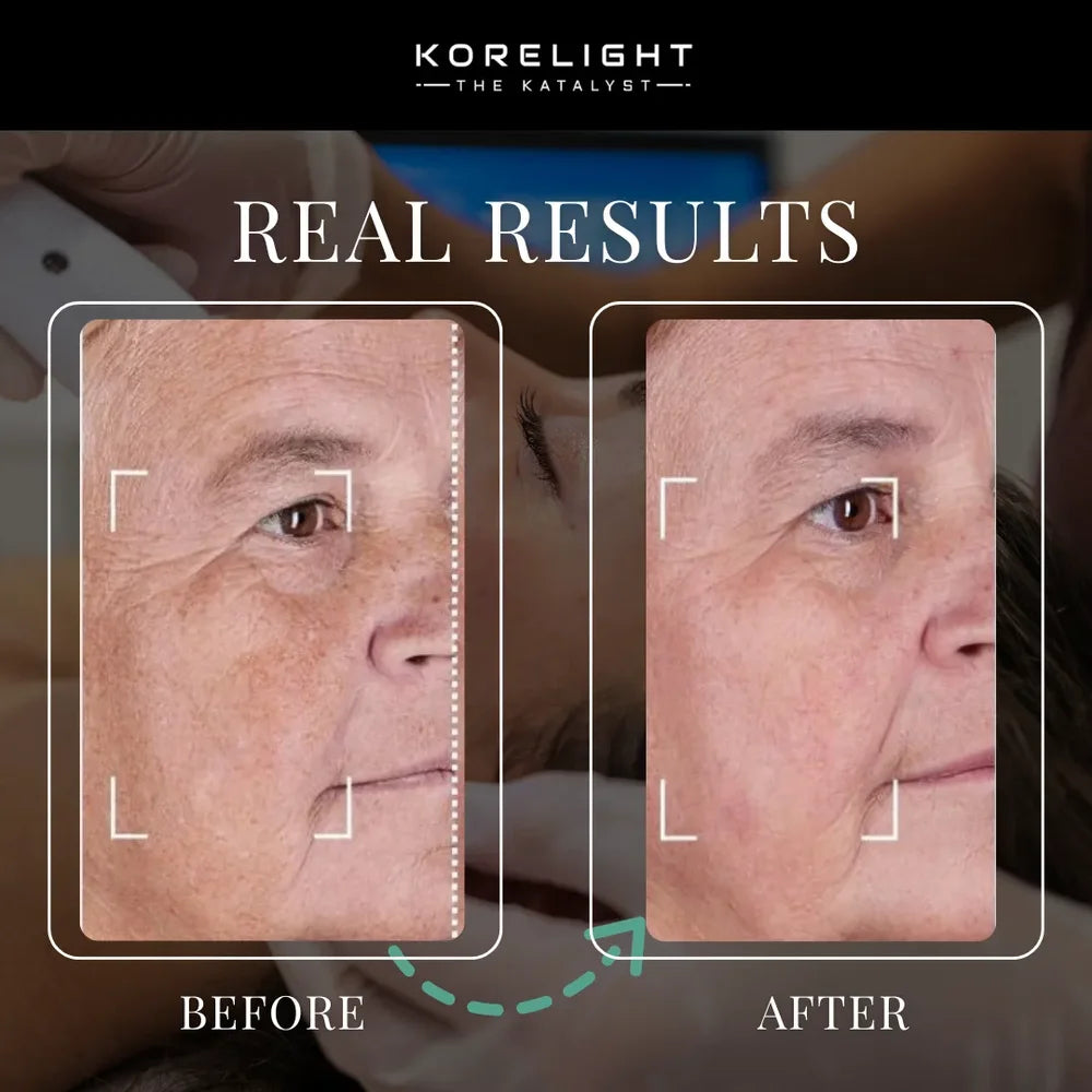 Before and after cheek wrinkles and sun spots showing results with the Kore ELITE Full Body Light Therapy Device