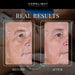 Before and after cheek wrinkles and sun spots showing results with the Kore ELITE Full Body Light Therapy Device