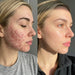Before and after cheek photos showing acne clearing during Lumara VISO LED Mask use