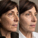 Mature skin before and after profile pair illustrating firmer looking results with the Lumara VISO Mask