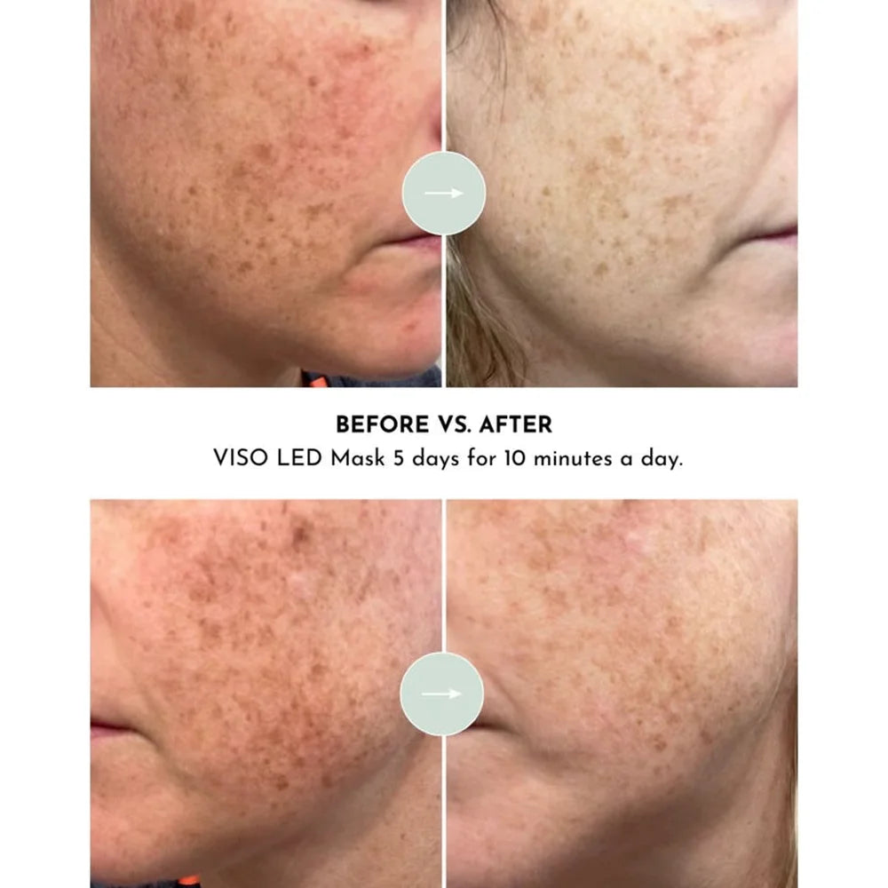 Close up cheek pigmentation before and after five days of ten minute Lumara VISO LED Mask sessions