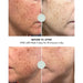 Close up cheek pigmentation before and after five days of ten minute Lumara VISO LED Mask sessions