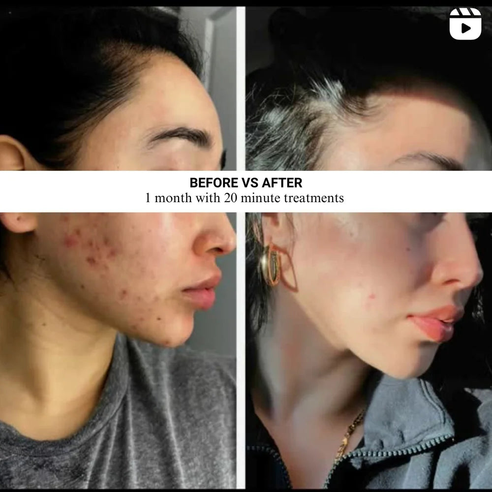 One month before and after grid with 20 minute sessions using the Lumara VISO LED Mask