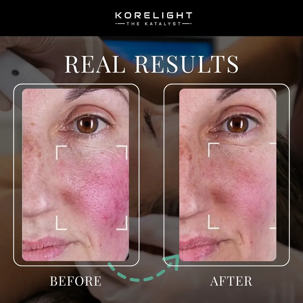 Calmer cheek redness and smoother texture after treatment with Kore ELITE Photobiomodulation Beds, side by side
