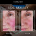 Calmer cheek redness and smoother texture after treatment with Kore ELITE Photobiomodulation Beds, side by side