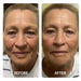 Before and after facial wrinkle comparison from anti-aging sessions with the Galaxy Zero Capsule