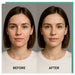 Woman with acne breakouts across her cheeks and chin, then smooth clear skin, with the KoreLight KoreMask Red Light Therapy Mask