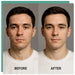 Young man with acne on cheeks and forehead beside clearer skin after the KoreLight KoreMask Light Therapy Mask